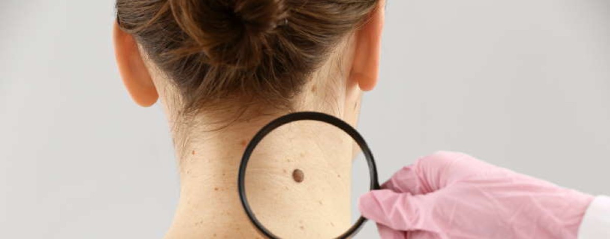 Melanoma. Nuova legge in Gazzetta prevede screening con farmacie, telemedicina e teleconsulto