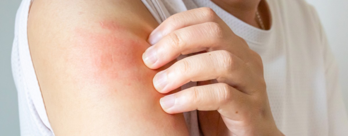 Dermatite atopica, dai polifenoli un supporto della barriera cutanea